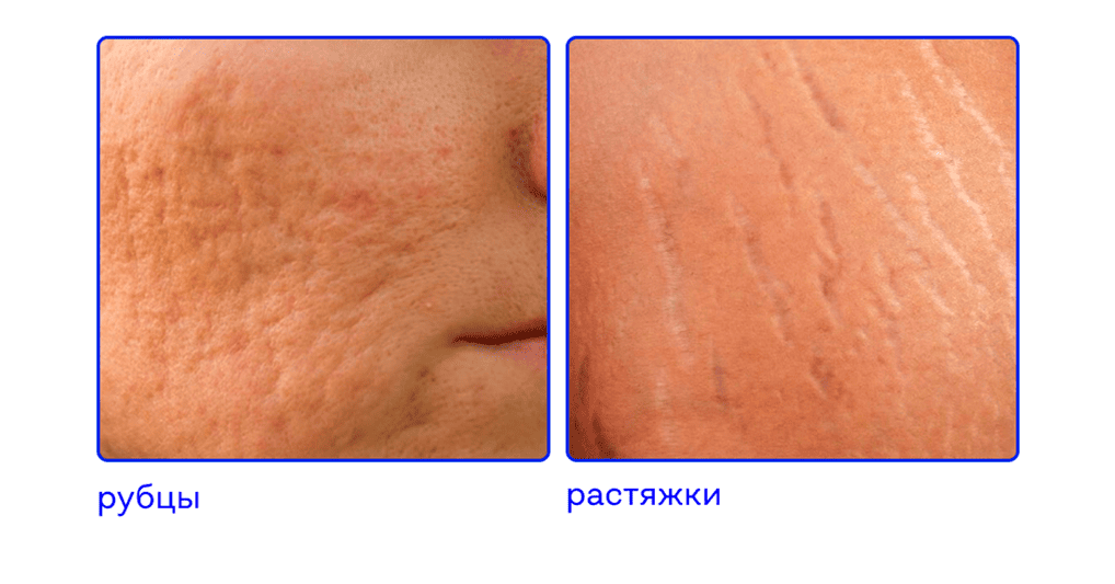 рубцы, растяжки 