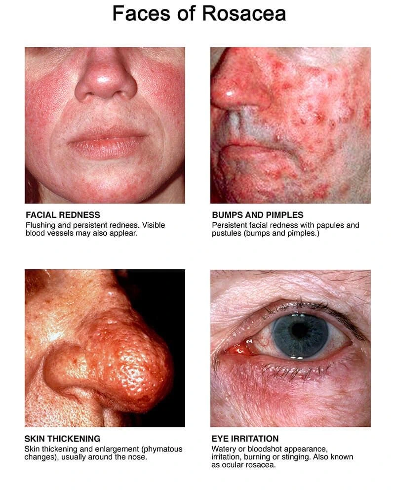 Face of Rosacea